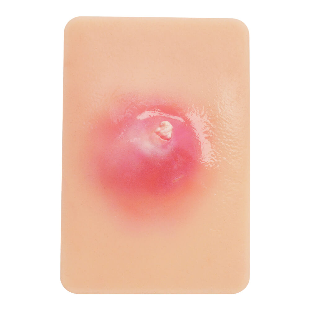 Bacterial Skin Infection Wound Model Set (4 Pieces)