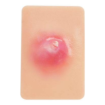 Bacterial Skin Infection Wound Model Set (4 Pieces)