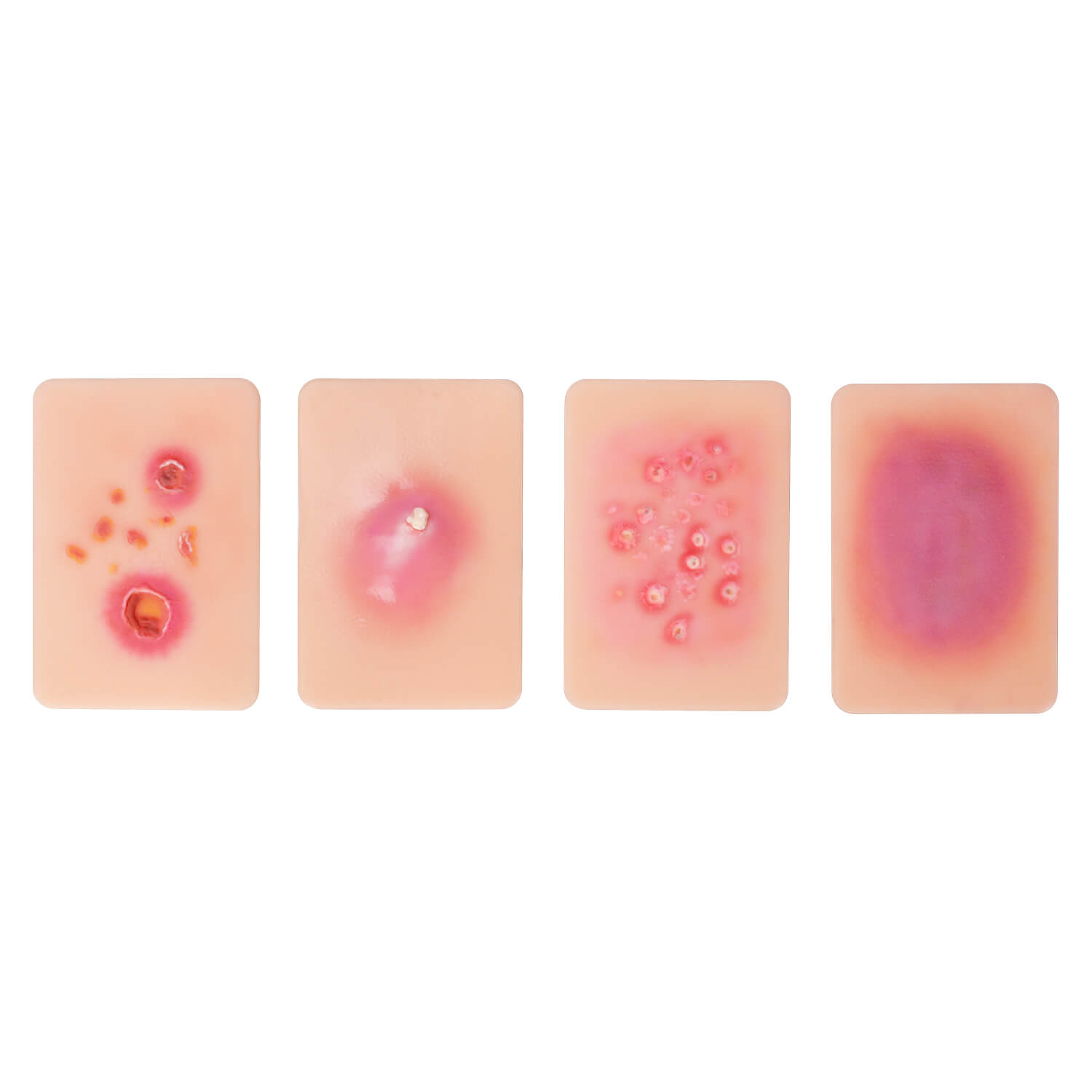 Bacterial Skin Infection Wound Simulation Models (Set of 4)