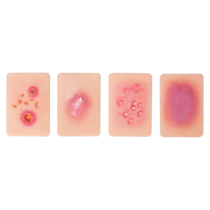 Bacterial Skin Infection Wound Simulation Models (Set of 4)