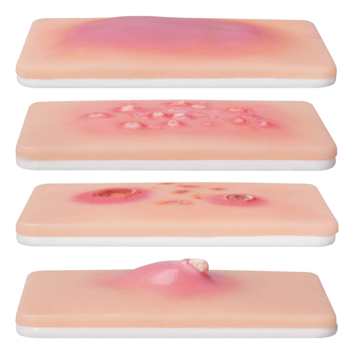 Bacterial Skin Infection Wound Simulation Models (Set of 4)