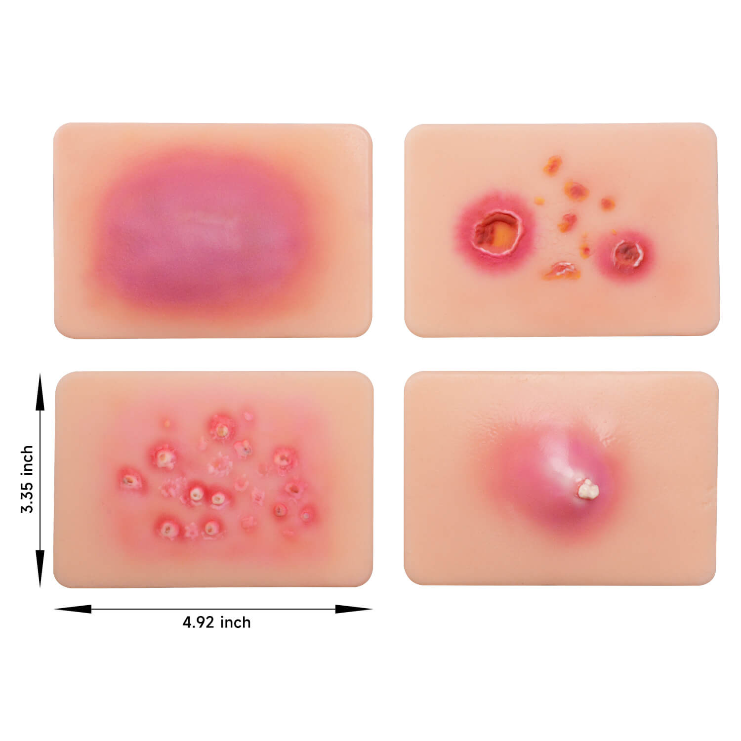 Bacterial Skin Infection Wound Simulation Models (Set of 4)