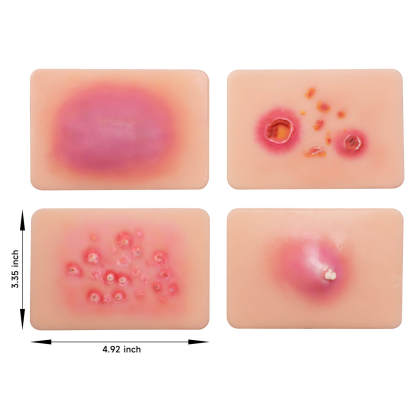 Bacterial Skin Infection Wound Simulation Models (Set of 4)