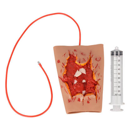 Trauma Blast Injury Wound Sleeve with Open Fracture