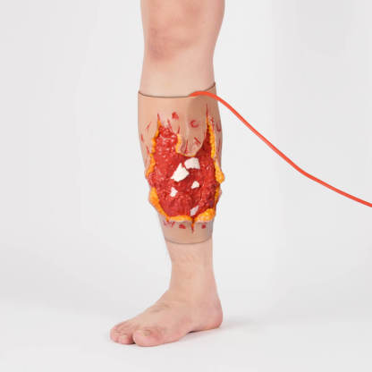 Trauma Blast Injury Wound Sleeve with Open Fracture