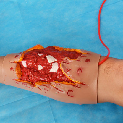 Trauma Blast Injury Wound Sleeve with Open Fracture