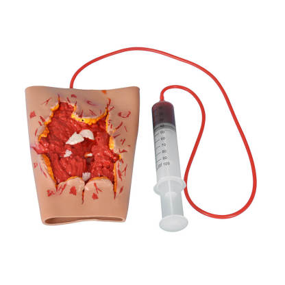 Trauma Blast Injury Wound Sleeve with Open Fracture
