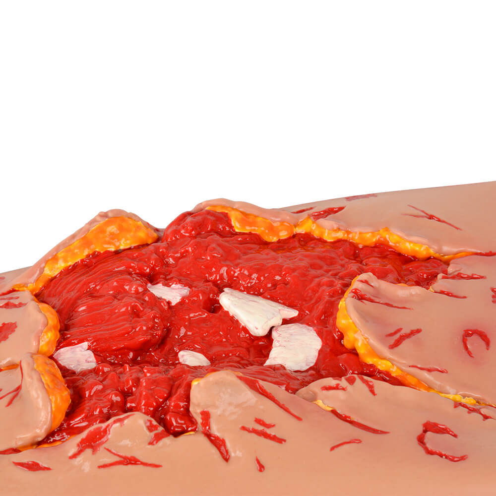 Trauma Blast Injury Wound Sleeve with Open Fracture