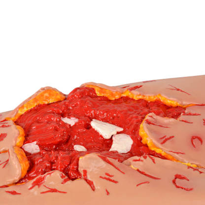 Trauma Blast Injury Wound Sleeve with Open Fracture