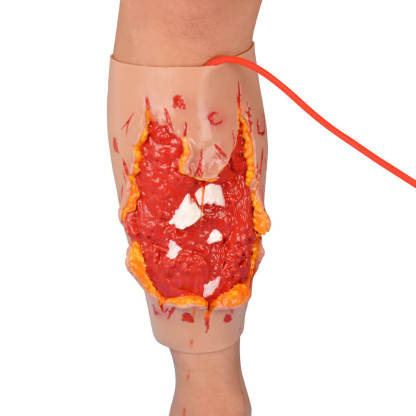 Trauma Blast Injury Wound Sleeve with Open Fracture