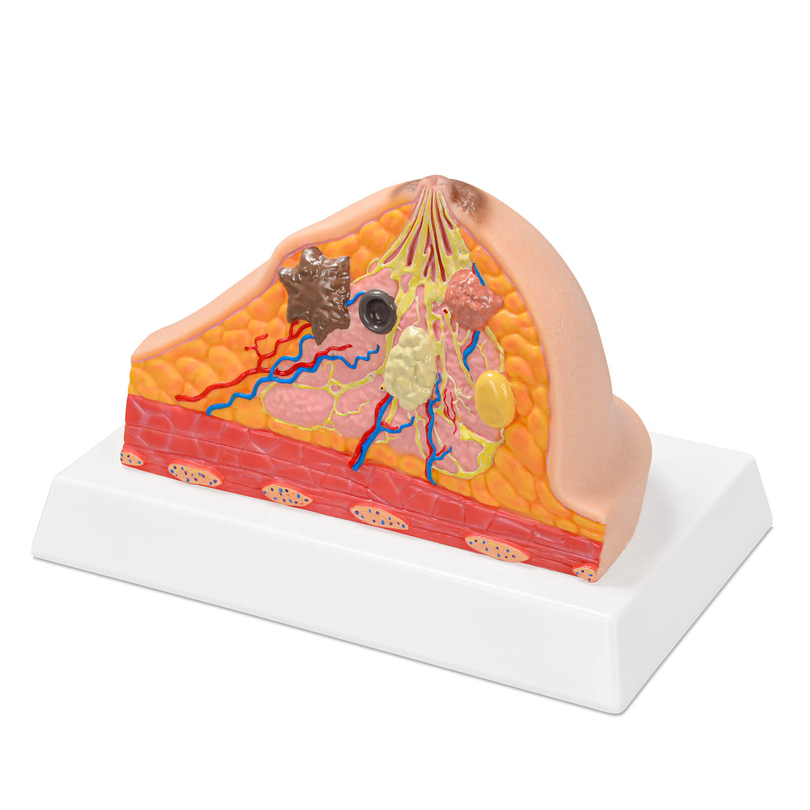 Anatomical Breast Model with Common Pathologies (Cross-Section)
