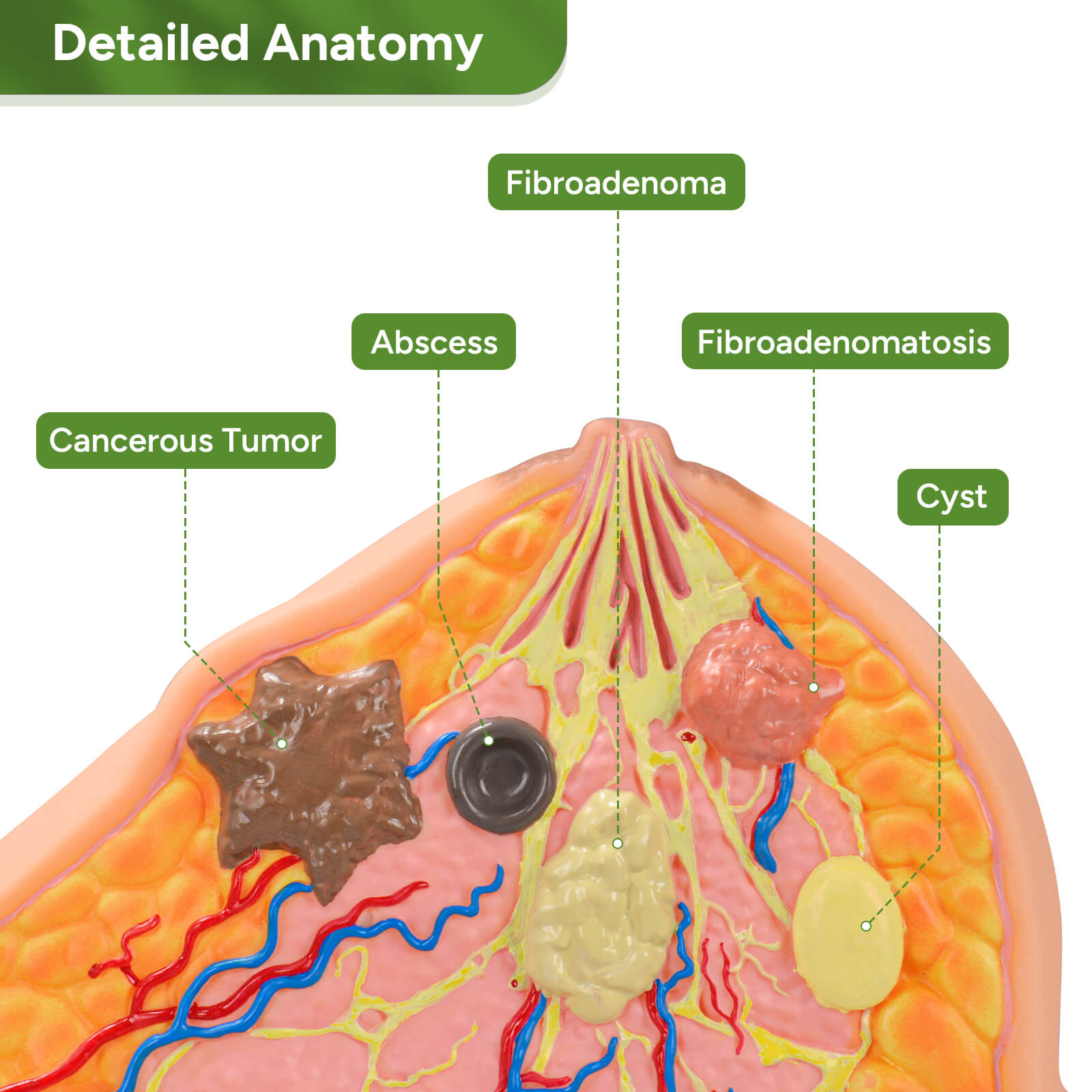 Anatomical Breast Model with Common Pathologies (Cross-Section)