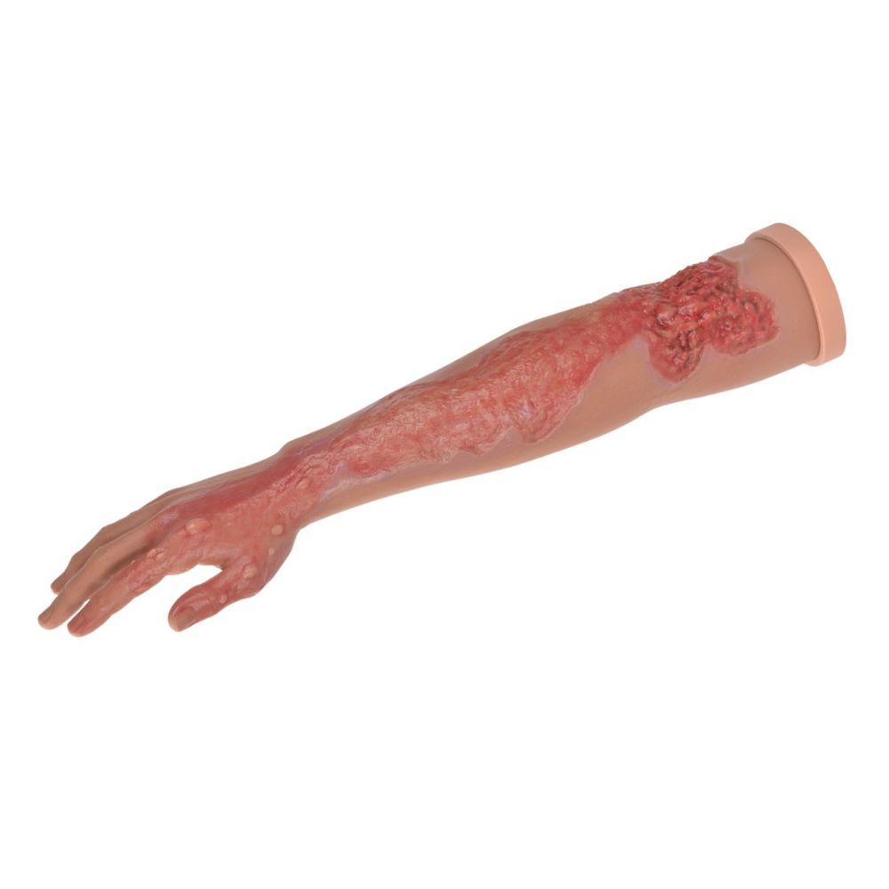Multi-Degree Burn Care Arm Model