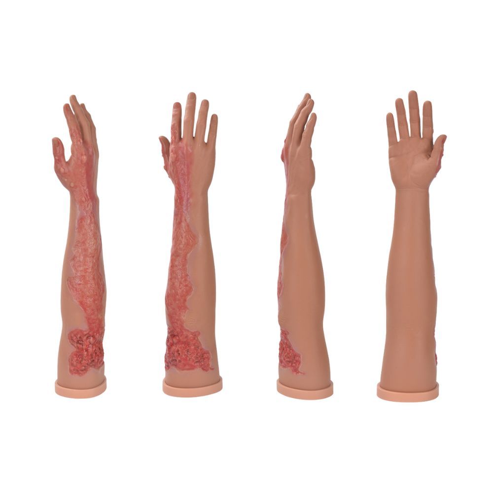 Multi-Degree Burn Care Arm Model