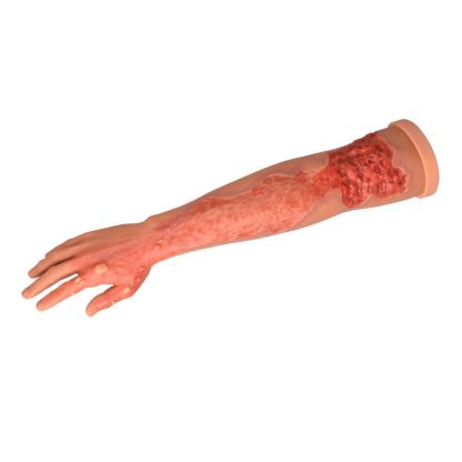 Multi-Degree Burn Wound Arm Training Model
