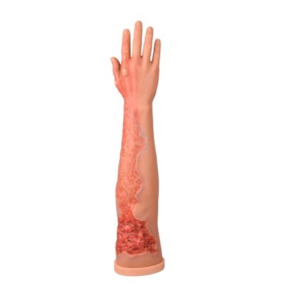 Multi-Degree Burn Wound Arm Training Model