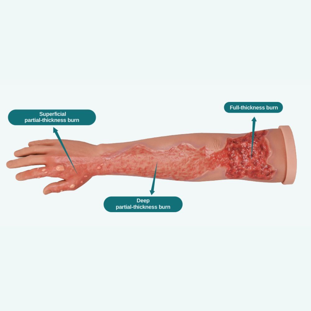 Multi-Degree Burn Wound Arm Training Model