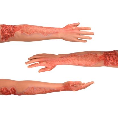 Multi-Degree Burn Wound Arm Training Model