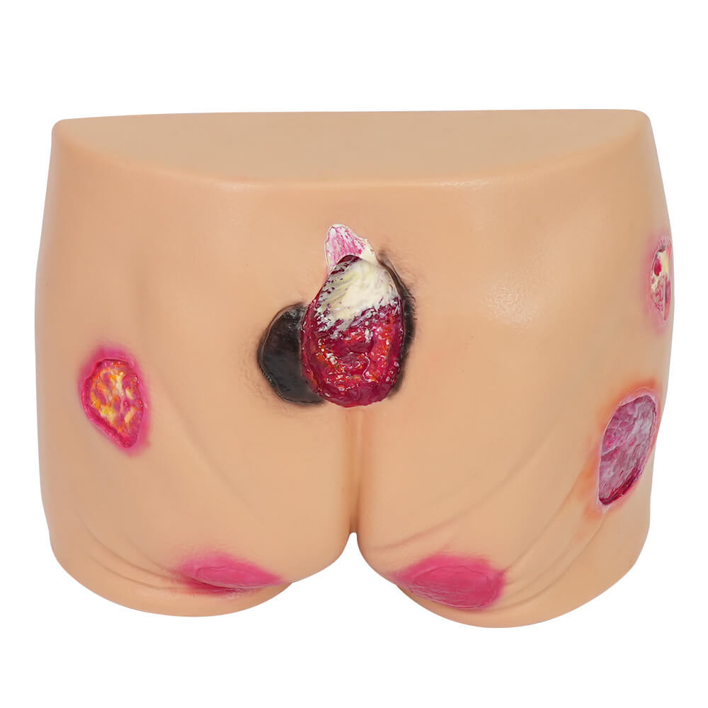 Buttocks Pressure Ulcer Demonstration Model