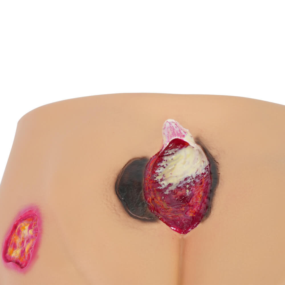 Buttocks Pressure Ulcer Demonstration Model