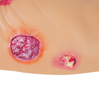 Buttocks Pressure Ulcer Demonstration Model