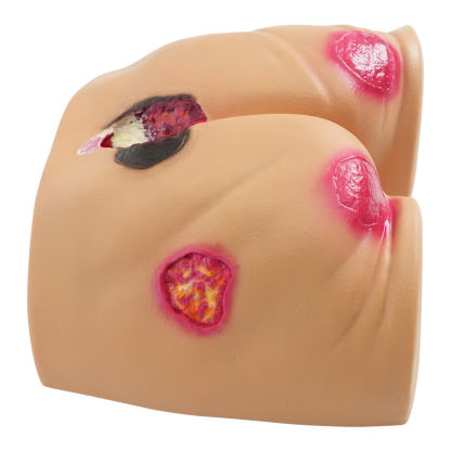 Buttocks Pressure Ulcer Demonstration Model