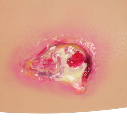 Buttocks Pressure Ulcer Demonstration Model