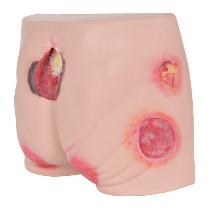 Buttocks Decubitus Wound Care Simulator