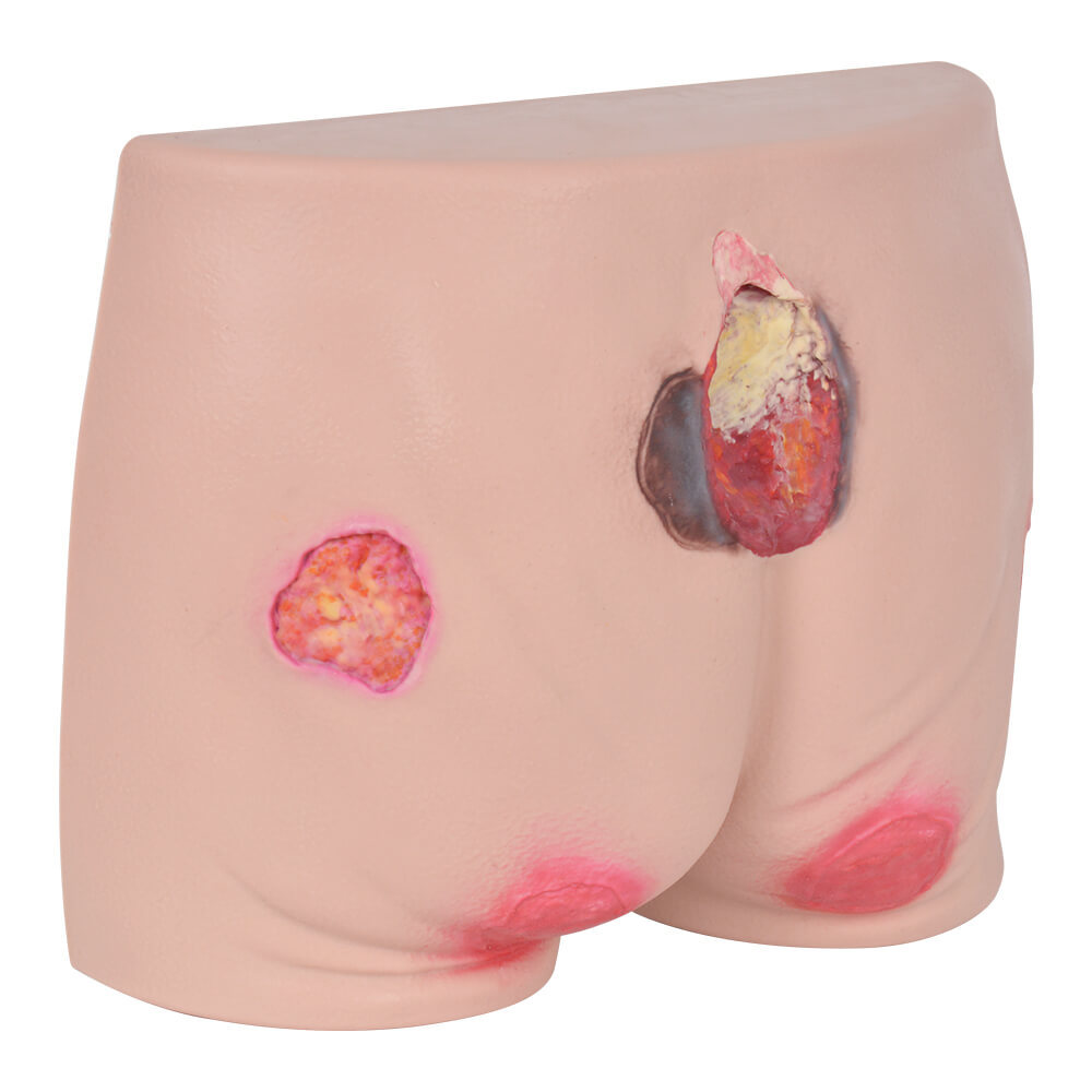Buttocks Decubitus Wound Care Simulator