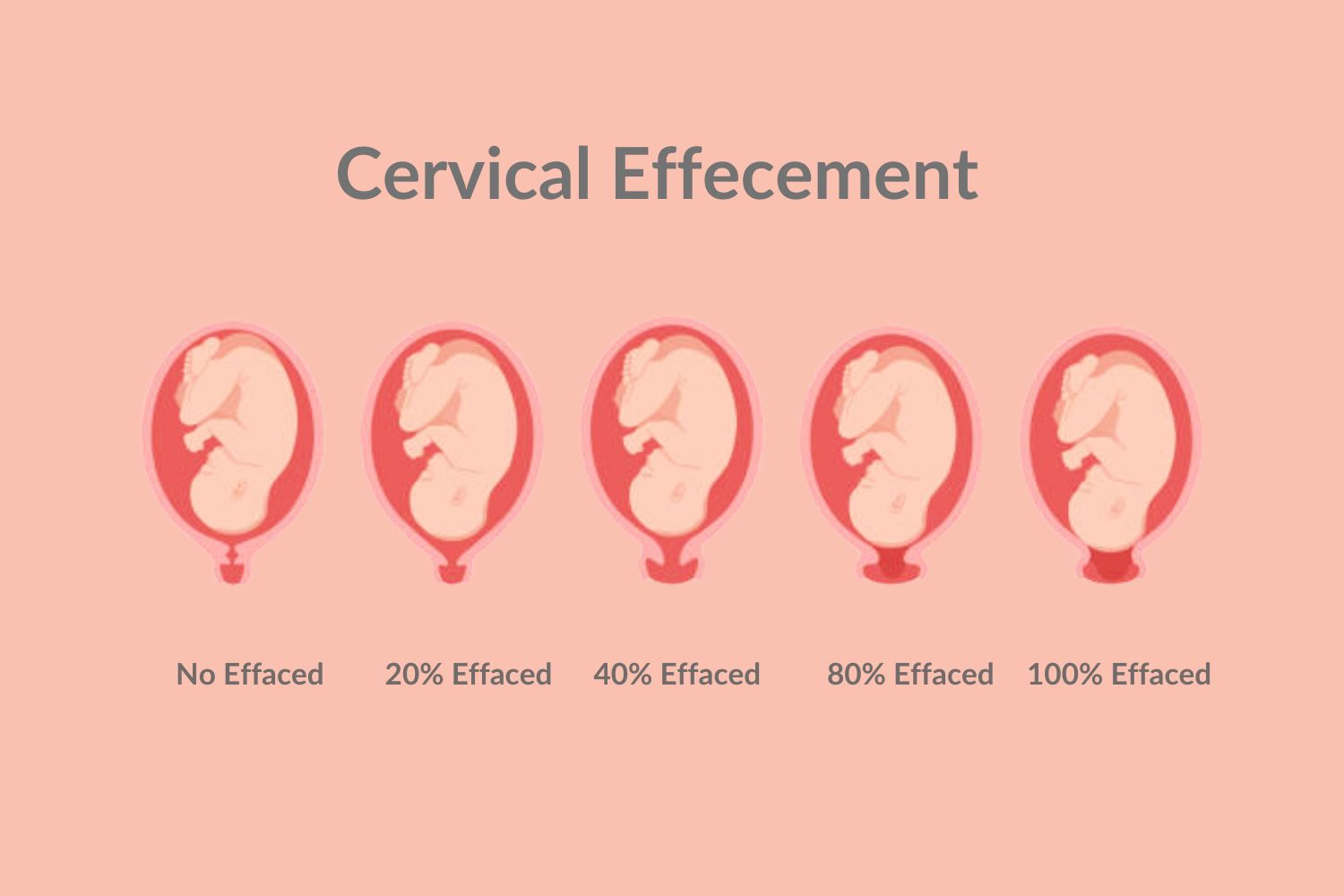 Cervical Dilatation vs. Effecement