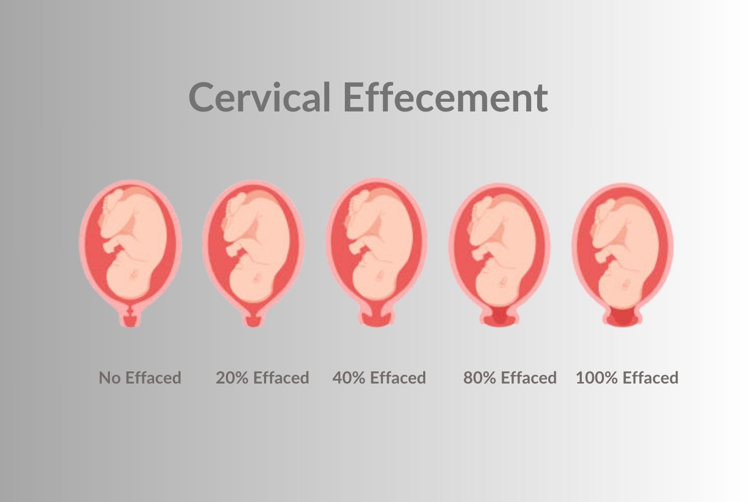 Cervical Effacement