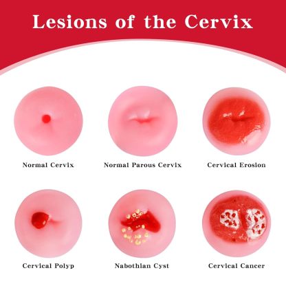Cervical Pathology Model with 6 Cervical Replicas