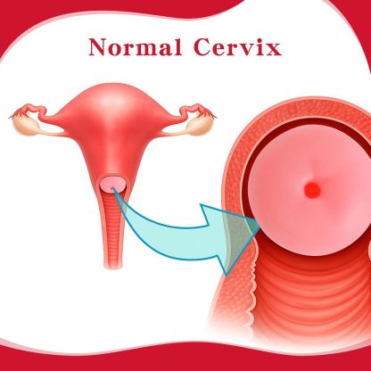 Cervical Pathology Model with 6 Cervical Replicas