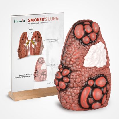  Smoking Cough Up Lung Model with Cross-Section Pathology