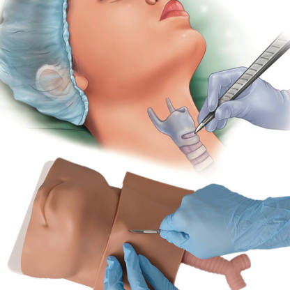 Ultrassist Cricothyrotomy Simulator for Emergency Training