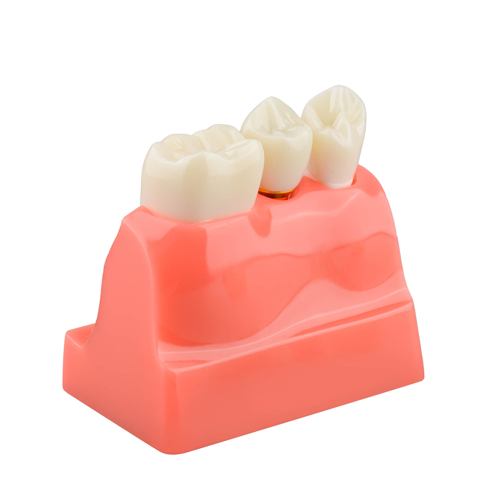 4X Dental Implant Model with Crown & Bridge - Pink