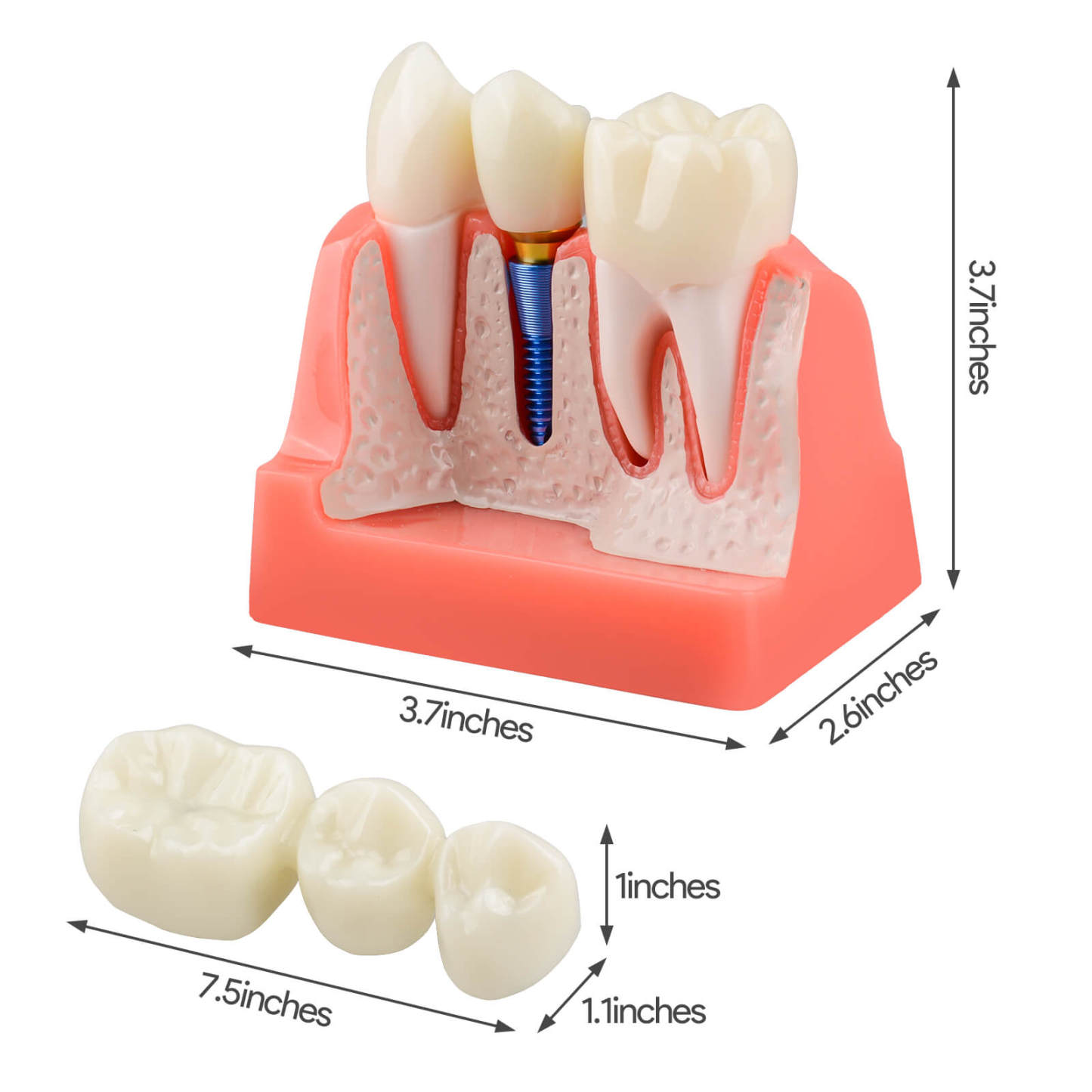 4X Dental Implant Model with Crown & Bridge - Pink