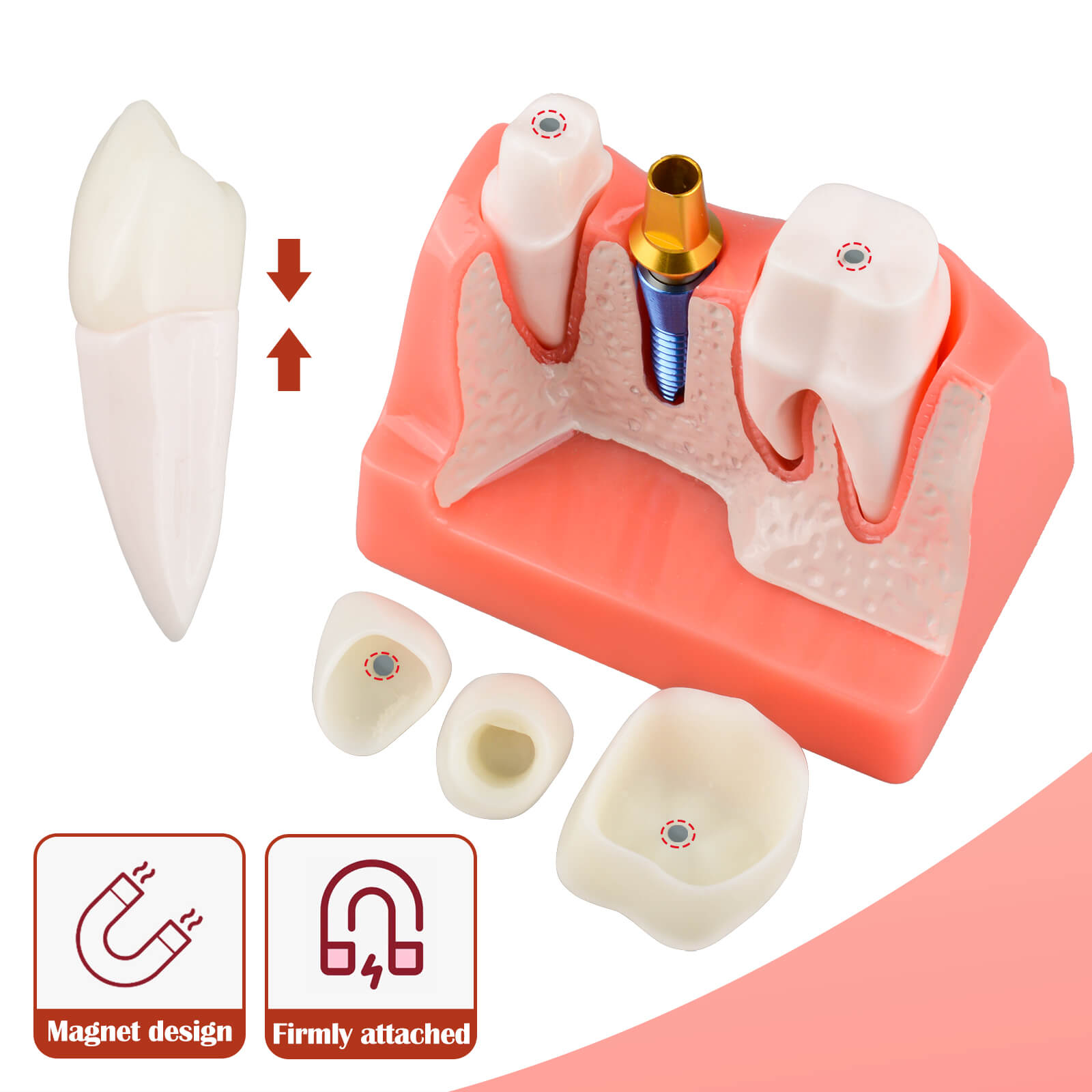 4X Dental Implant Model with Crown & Bridge - Pink