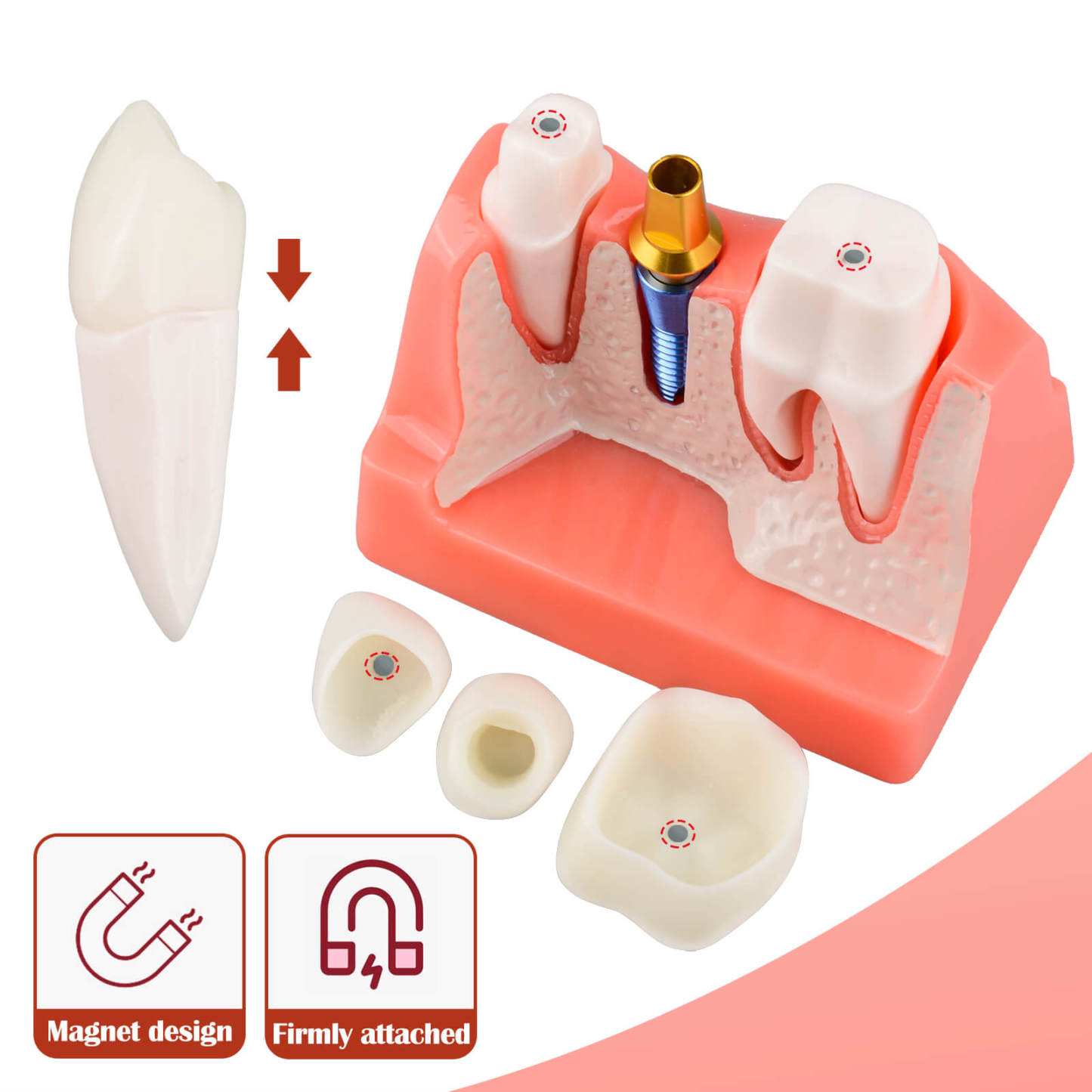 4X Dental Implant Model with Crown & Bridge - Pink