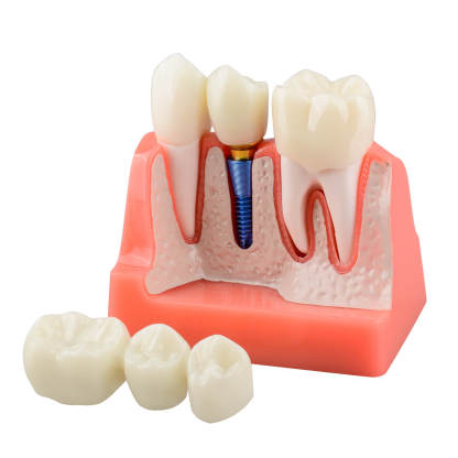 4X Dental Implant Model with Crown & Bridge - Pink