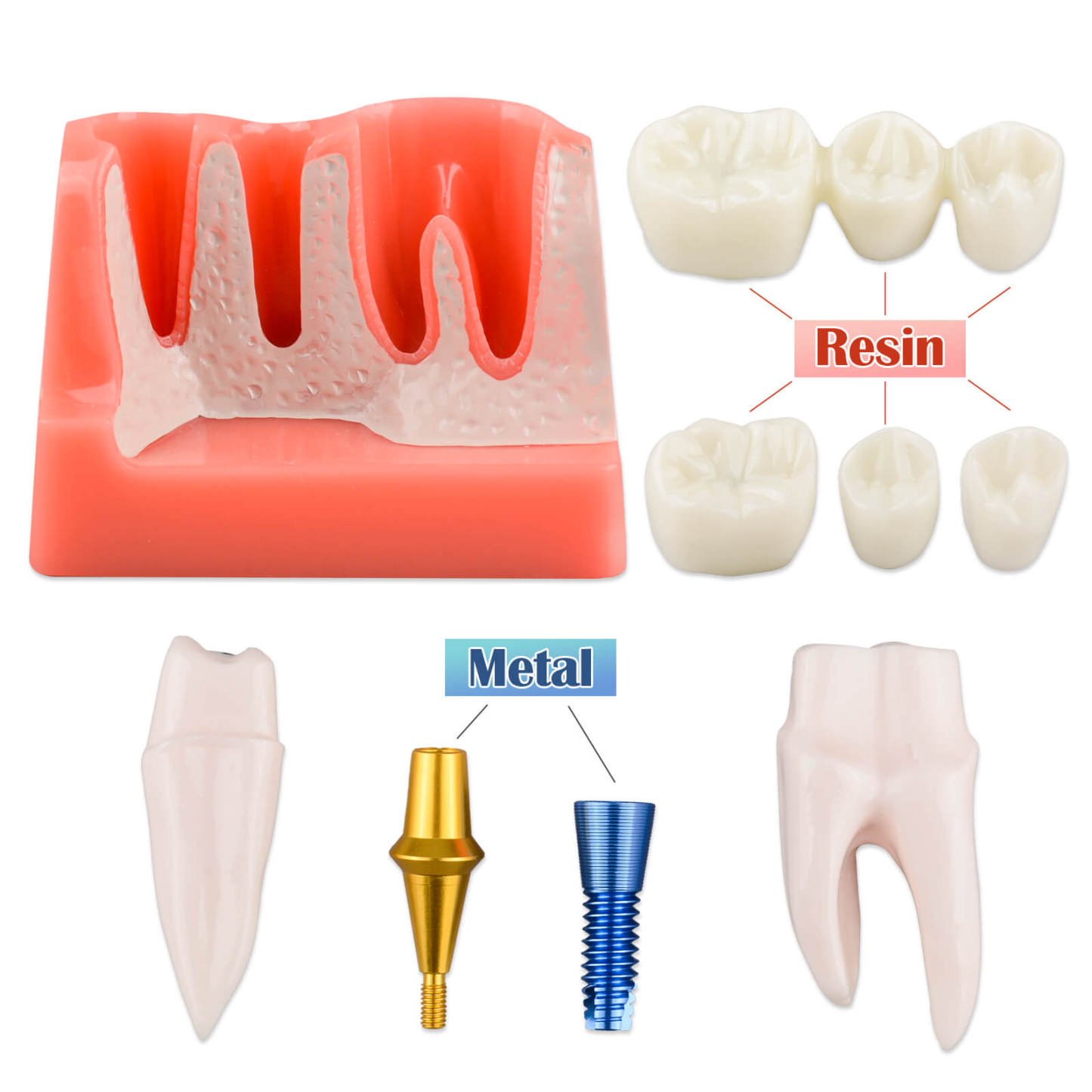 4X Dental Implant Model with Crown & Bridge - Pink