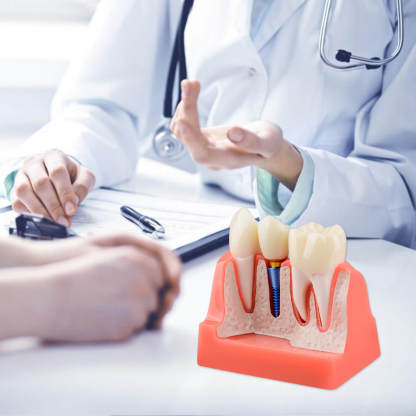 4X Dental Implant Model with Crown & Bridge - Pink