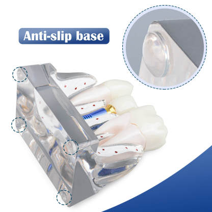 4X Transparent Dental Implant Model with Bridge & Crown