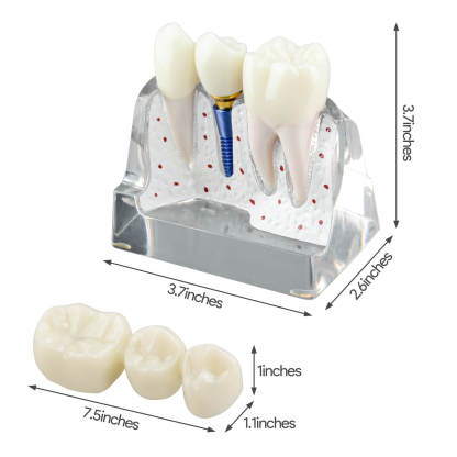 4X Transparent Dental Implant Model with Bridge & Crown