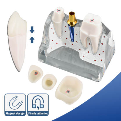 4X Transparent Dental Implant Model with Bridge & Crown