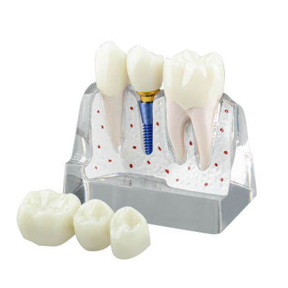 4X Transparent Dental Implant Model with Bridge & Crown