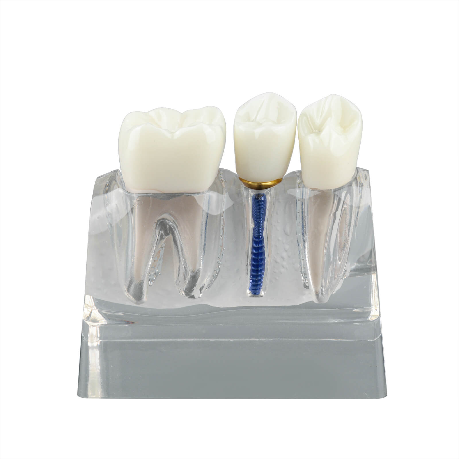 4X Transparent Dental Implant Model with Bridge & Crown