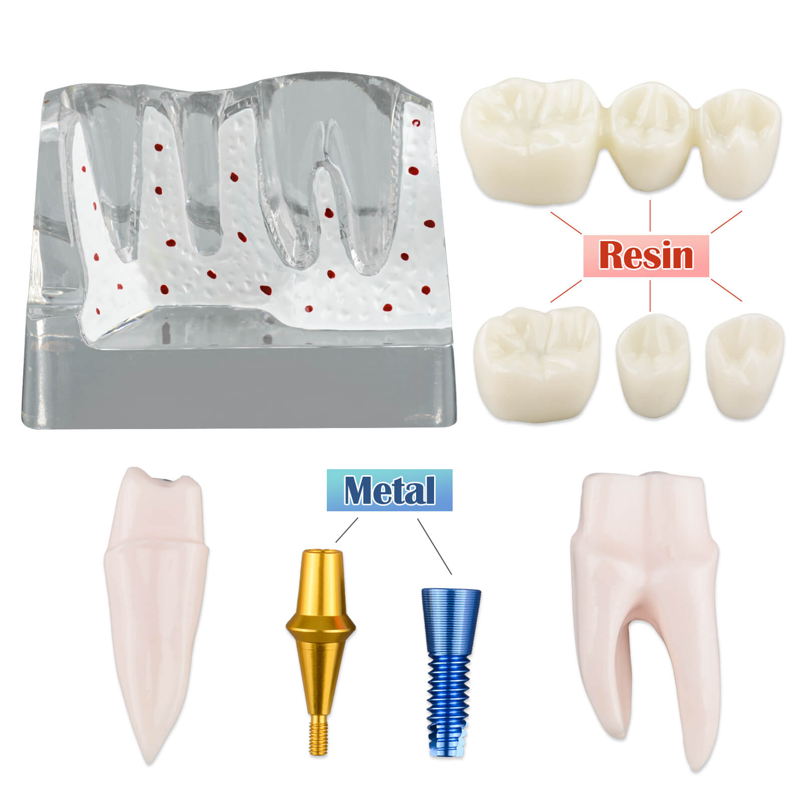 4X Transparent Dental Implant Model with Bridge & Crown