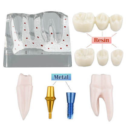 4X Transparent Dental Implant Model with Bridge & Crown
