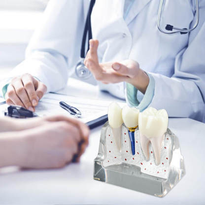 4X Transparent Dental Implant Model with Bridge & Crown